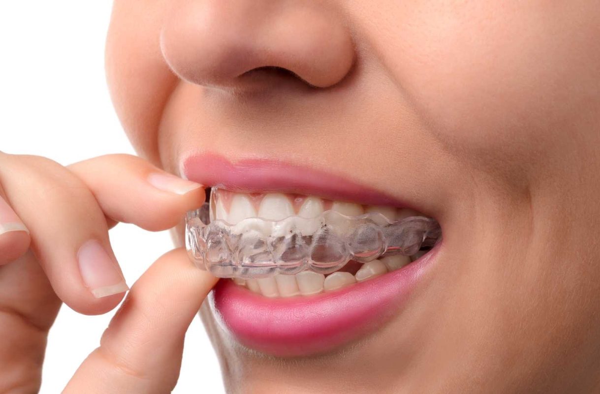 Is invisalign worth it? The Pros of Invisalign
