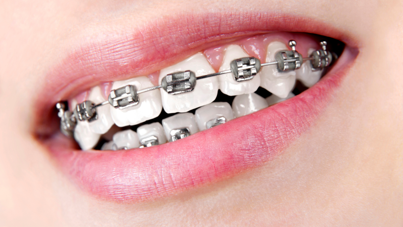 Are braces worth it? Traditional Metal Braces