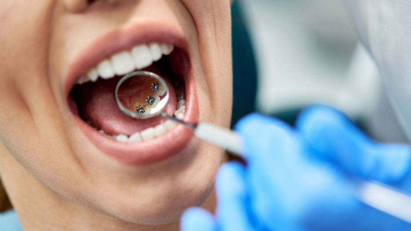 Are braces worth it? Lingual Braces: Alignment Behind the Scenes