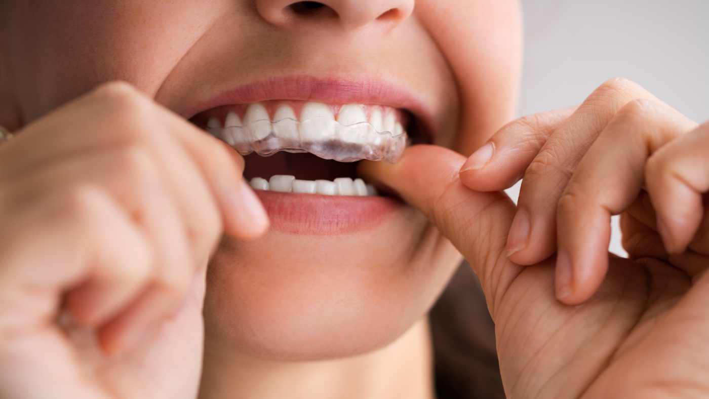 Are braces worth it? Clear Aligners: Removable and Convenient