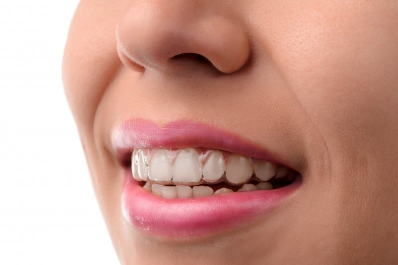 How Does Invisalign Work? (The Process), Step 4: Wearing the Aligners