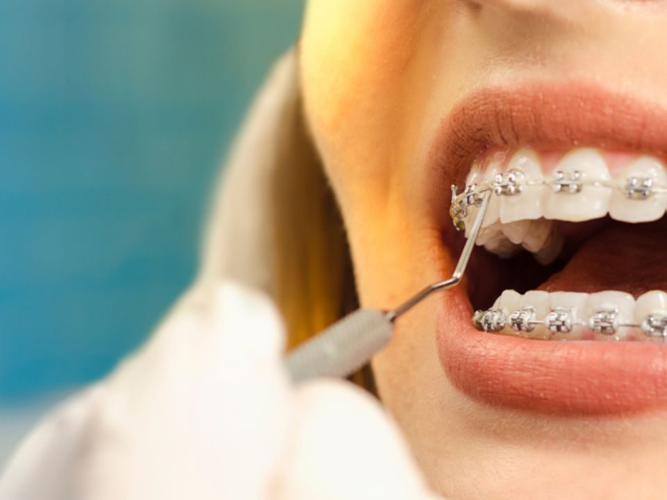 Are Braces Worth It for Adults? Absolutely Yes!
