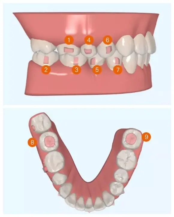 How Does Invisalign Work? (The Principle)